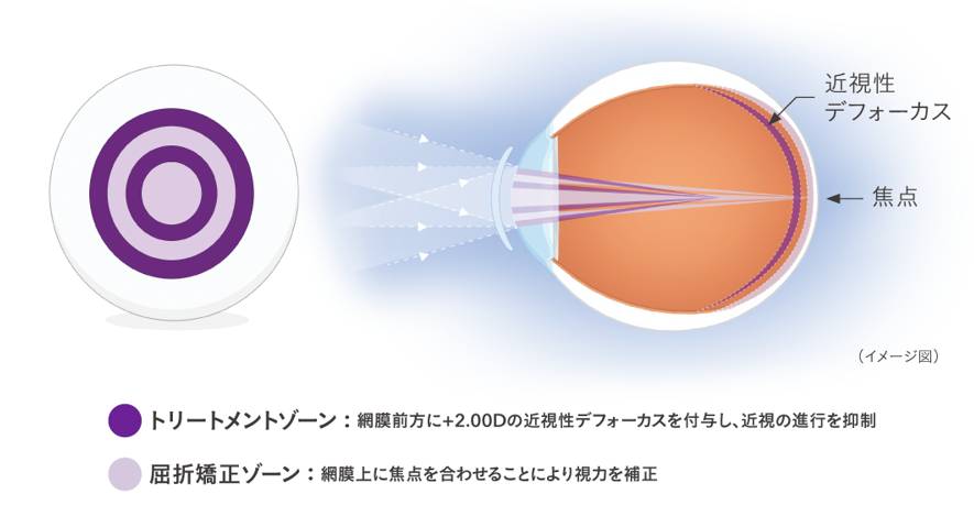 MiSight 1day