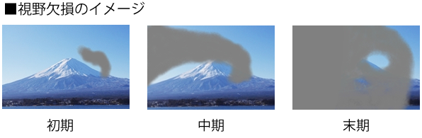 緑内障