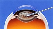 水晶体前嚢を切開する