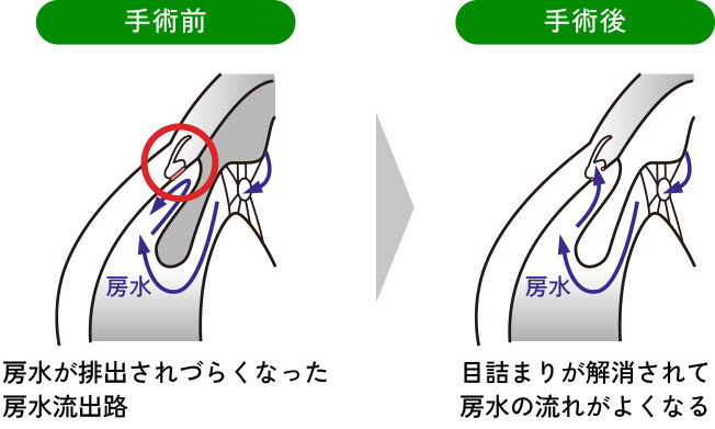緑内障手術(トラベクロトミー)