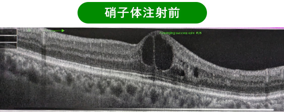 硝子体注射前