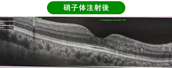 硝子体注射後